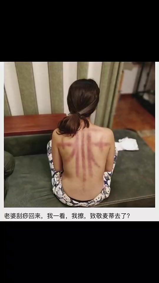 老婆这刮痧是去致敬麦迪吗还真有点像啊